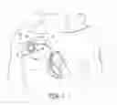 Fig. 02 - Reduction of infection associated with medical device