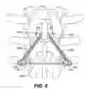 Fig. 08 - Device and method for correcting a spinal deformity