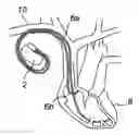 Fig. 01 - Medical device for detecting ischemia and a method for such a device