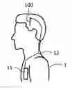 Fig. 01 - ELECTRODE SYSTEM FOR DEEP BRAIN STIMULATION