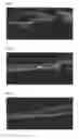 Fig. 02 - Method of oscillatory thermotherapy of biological tissue