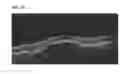 Fig. 06 - Method of oscillatory thermotherapy of biological tissue