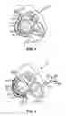Fig. 02 - Adjustable height focal tissue deflector