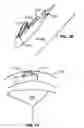 Fig. 06 - Adjustable height focal tissue deflector