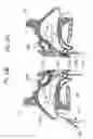 Fig. 09 - Devices, systems and methods for diagnosing and treating sinusitus and other disorder of the ears, nose and/or throat