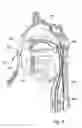 Fig. 22 - Devices, systems and methods for diagnosing and treating sinusitus and other disorder of the ears, nose and/or throat