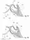 Fig. 35 - Devices, systems and methods for diagnosing and treating sinusitus and other disorder of the ears, nose and/or throat