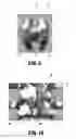 Fig. 07 - Swellable interspinous stabilization implant