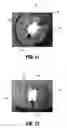 Fig. 08 - Swellable interspinous stabilization implant
