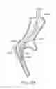 Fig. 49 - Elongated lung volume reduction devices, methods, and systems
