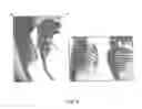 Fig. 04 - CRANIAL AND VERTEBRAL DEFECTS ASSOCIATED WITH LOSS-OF-FUNCTION OF NELL1