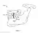 Fig. 02 - Apparatus, system, and method for maxillo-mandibular fixation