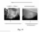 Fig. 08 - MICROFLUIDIC SYSTEMS INCLUDING POROUS POLYMER ELECTRODES