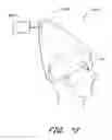 Fig. 16 - Method for providing phototherapy to the brain