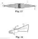 Fig. 13 - Surgical needle and anchor system with retractable features