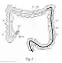 Fig. 05 - SYSTEM AND METHOD FOR NAVIGATING A TOOL WITHIN A BODY CONDUIT