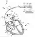 Fig. 01 - Methods and systems for recharging an implanted device by delivering a section of a charging device adjacent the implanted device within a body
