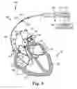 Fig. 09 - Methods and systems for recharging an implanted device by delivering a section of a charging device adjacent the implanted device within a body