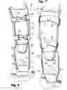 Fig. 04 - Orthotic Assembly for Selectively off-Loading a Weight-Bearing Joint