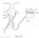 Fig. 04 - System and methods for endovascular aneurysm treatment