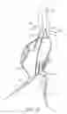Fig. 17 - System and methods for endovascular aneurysm treatment