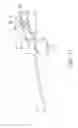 Fig. 32 - Indwelling needle assembly