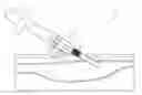 Fig. 01 - Surgical methods, devices, and kits