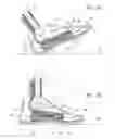 Fig. 06 - Foot prosthesis having cushioned ankle