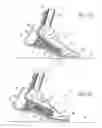Fig. 07 - Foot prosthesis having cushioned ankle