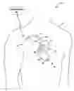 Fig. 01 - CARDIAC RISK STRATIFICATION UTILIZING BAROREFLEX SENSITIVITY MEASUREMENT