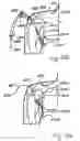 Fig. 75 - Apparatus for tissue repair