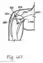 Fig. 76 - Apparatus for tissue repair