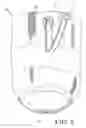 Fig. 03 - Prosthetic attachment system with low profile attachment pad