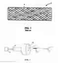Fig. 02 - Method of inserting self-expandable stent in a sheath