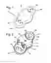 Fig. 02 - Opener for plastic bottle twist caps