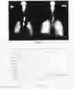 Fig. 07 - SOLID LIPIDIC PARTICLES AS PHARMACEUTICALLY ACCEPTABLE FILLERS OR CARRIERS FOR INHALATION