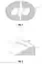 Fig. 03 - Method and apparatus for meniscal repair