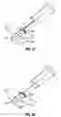 Fig. 16 - Method and apparatus for meniscal repair