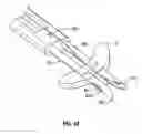 Fig. 30 - Method and apparatus for meniscal repair