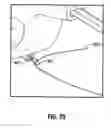 Fig. 56 - Method and apparatus for meniscal repair