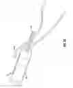 Fig. 57 - Method and apparatus for meniscal repair