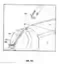 Fig. 75 - Method and apparatus for meniscal repair