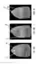 Fig. 10 - METHODS AND APPARATUS FOR COMBINED 4D PRESENTATION OF QUANTITATIVE REGIONAL PARAMETERS ON SURFACE RENDERING