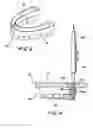 Fig. 03 - Reinforced thin-shell molds