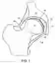 Fig. 02 - Device and method for restoring joints with artificial cartilage