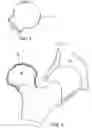 Fig. 05 - Device and method for restoring joints with artificial cartilage