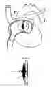 Fig. 01 - Self-Expanding Medical Occlusion Device