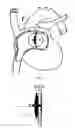 Fig. 18 - Self-Expanding Medical Occlusion Device