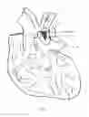 Fig. 24 - Self-Expanding Medical Occlusion Device
