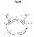 Fig. 03 - Apparatus for correcting an ingrown nail